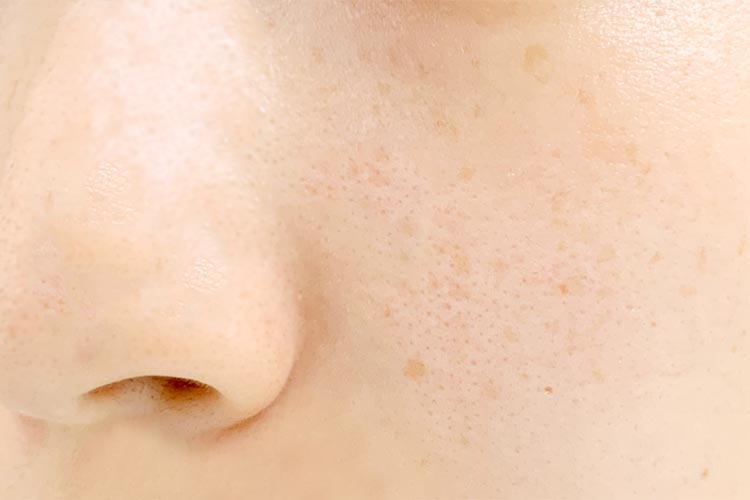 そばかすとは