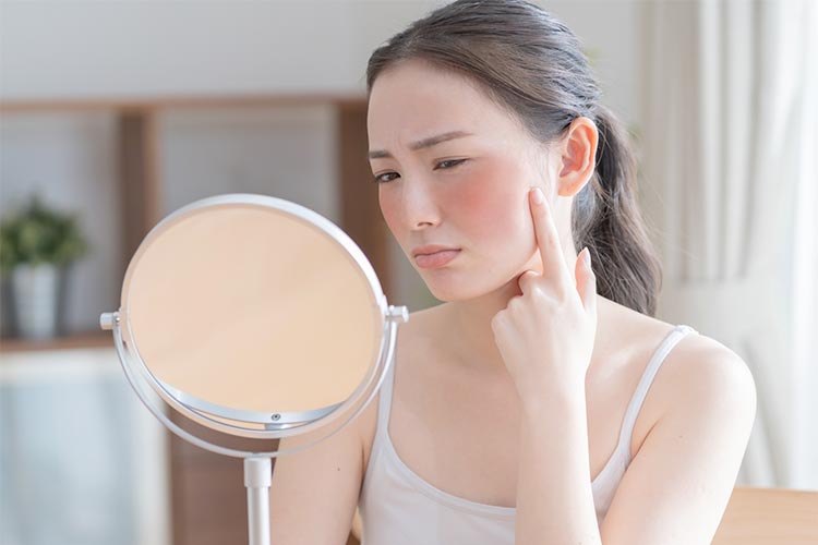 赤ら顔・肌の赤みとは