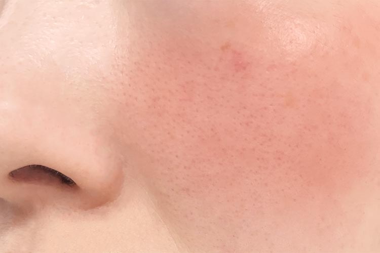 毛細血管拡張症とは